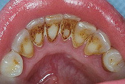 системы отбеливания зубов